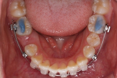 부산치아교정잘하는곳