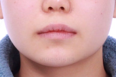 부산앞니벌어짐교정