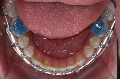 부산왜소치교정