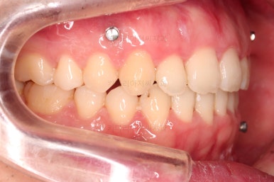 부산긴얼굴긴턱교정