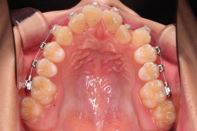 부산비발치교정