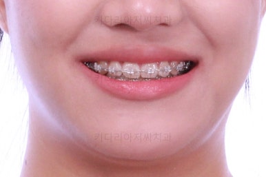 연산동치아교정치과