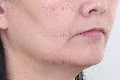 부산옥니교정