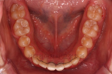 연산동치아교정