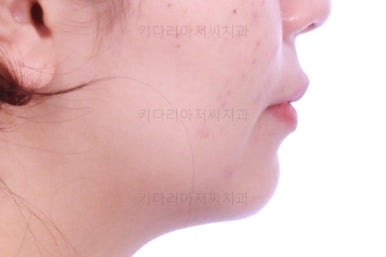 부산사랑니교정