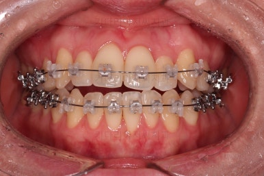 부산치아교정잘하는곳