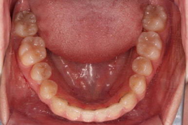 부산치아교정추천