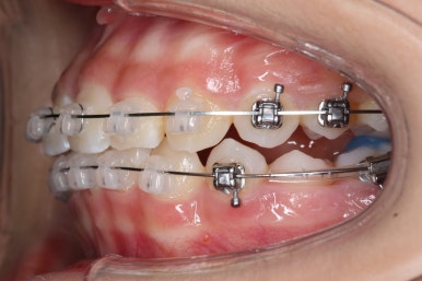 부산치아교정잘하는곳