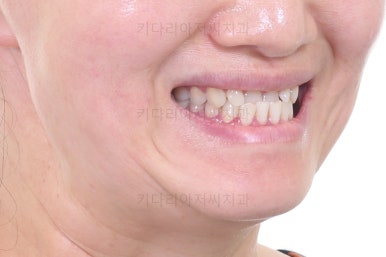 부산치아교정잘하는곳