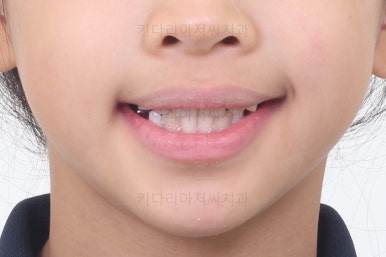 부산어린이반대교합