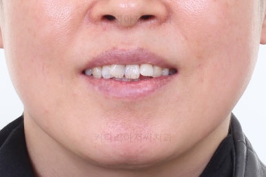 동래임플란트교정