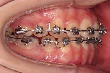 동래구치아교정