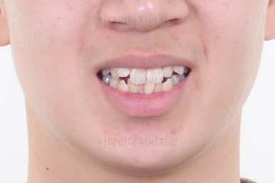 부산청소년치아교정