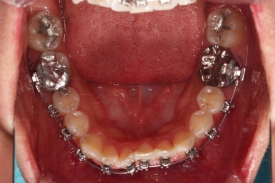 부산안면비대칭