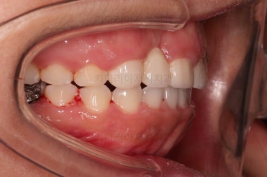 부산구순구개열