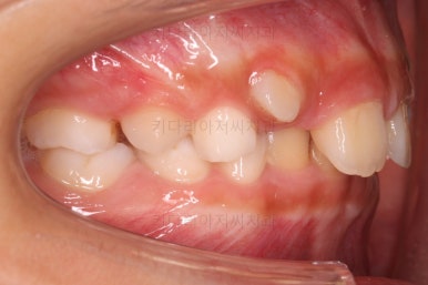 부산어린이돌출입교정