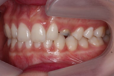 부산매복치아교정