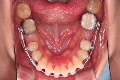 부산사랑니교정