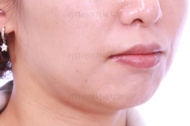 부산연산동교정치과