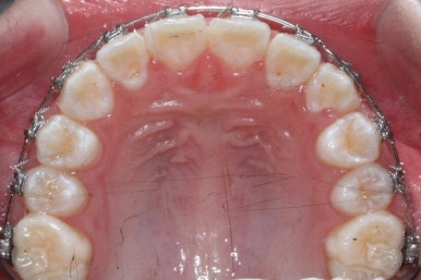 연산동덧니교정