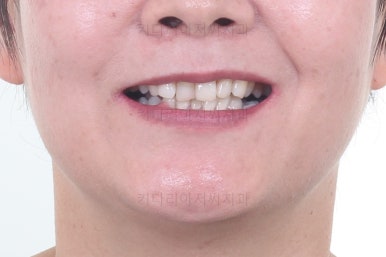 부산옥니교정