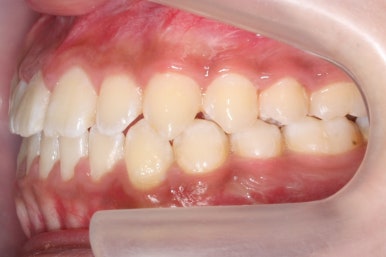 부산주걱턱교정
