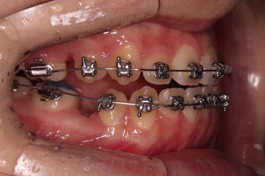 동래구치아교정