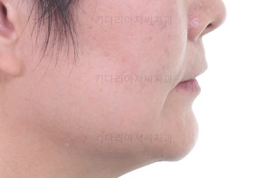 부산옥니교정
