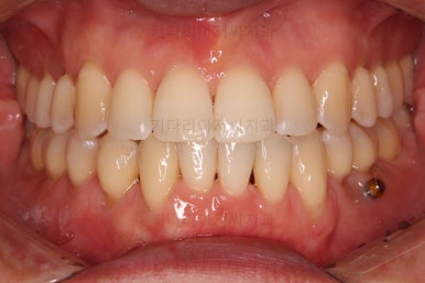 부산비수술교정