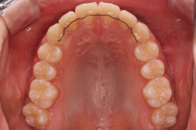 부산비발치교정