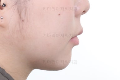 부산연산동교정치과