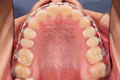 부산연산역치아교정