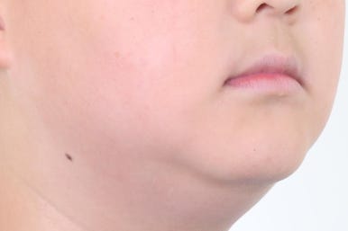 부산비발치교정