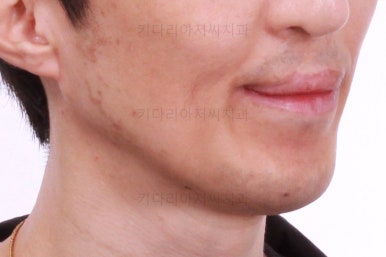 부산구순구개열교정