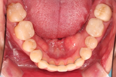 부산구순구개열교정