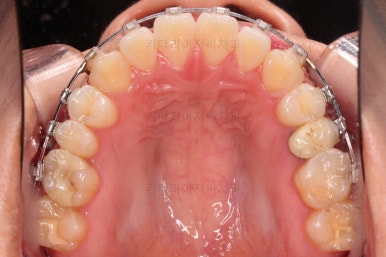 부산치아교정잘하는곳