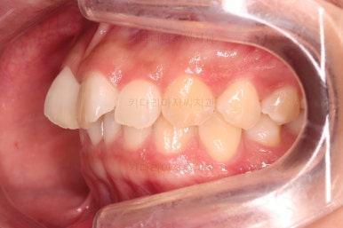 부산앞니부분교정