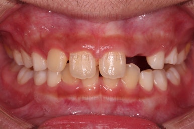 부산어린이돌출입교정