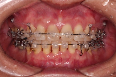 동래임플란트교정
