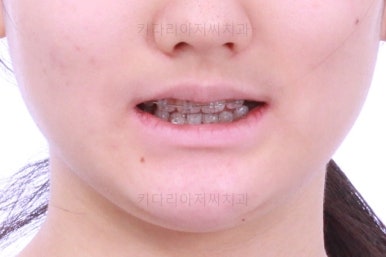 연산동치아교정