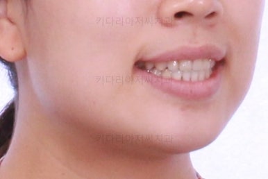 부산비발치교정