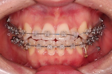 부산비발치교정