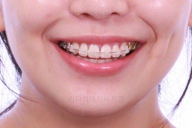 부산사랑니교정