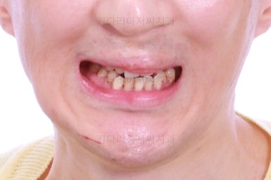 부산구순구개열교정