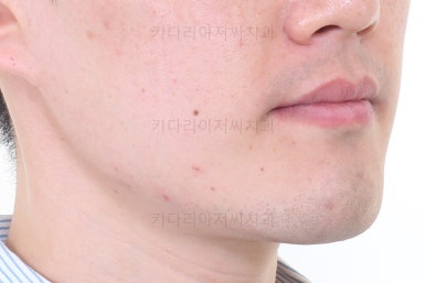 부산비수술교정