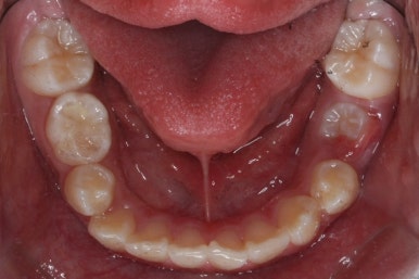 연산동덧니교정