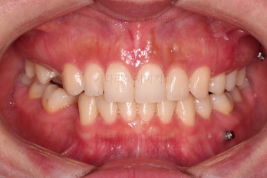 부산인비절라인