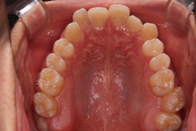 부산청소년치아교정