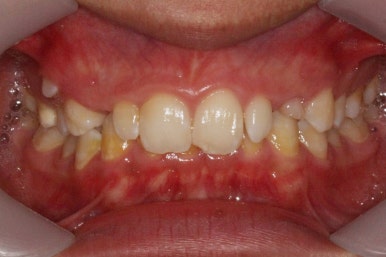 부산왜소치교정