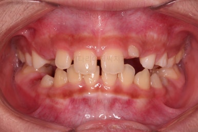 부산어린이돌출입교정